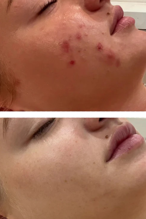 ClearComplex Acne Serum