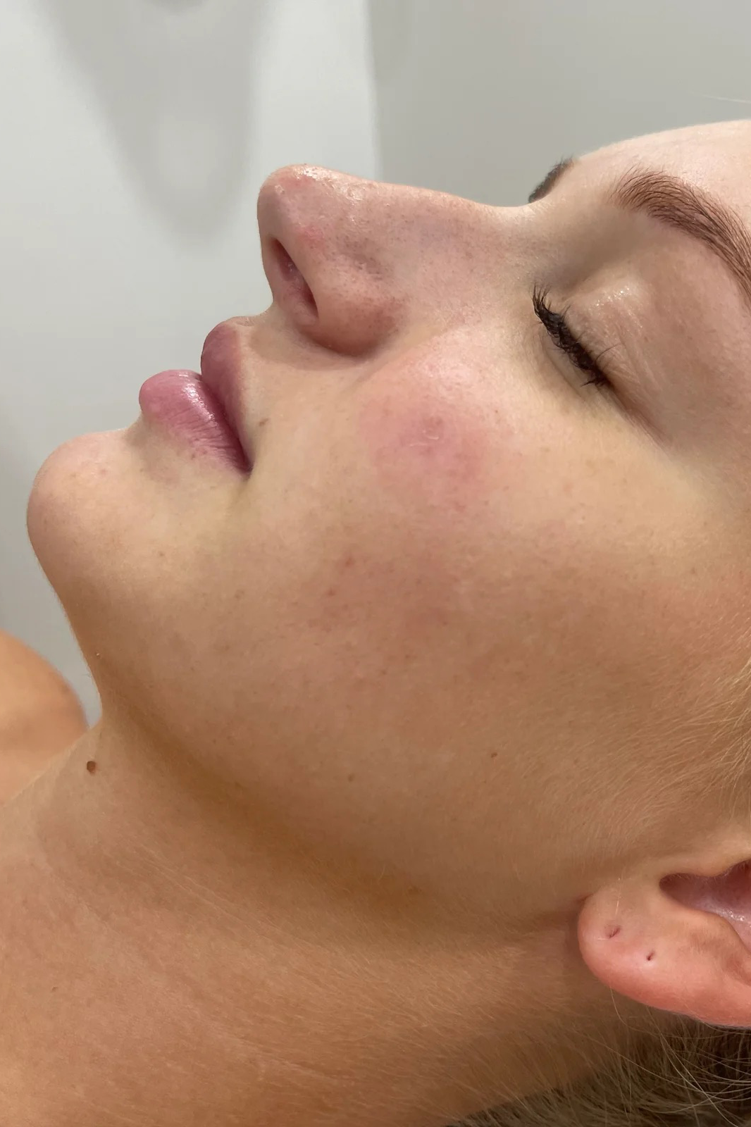 ClearComplex Acne Serum