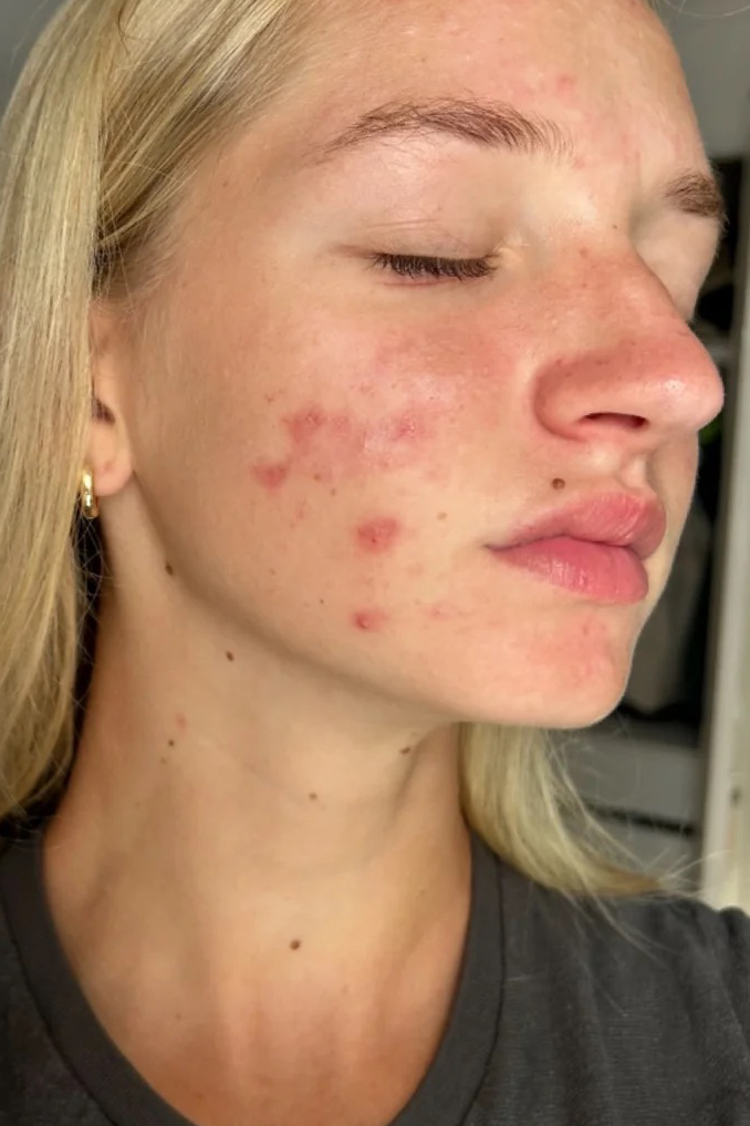 ClearComplex Acne Serum