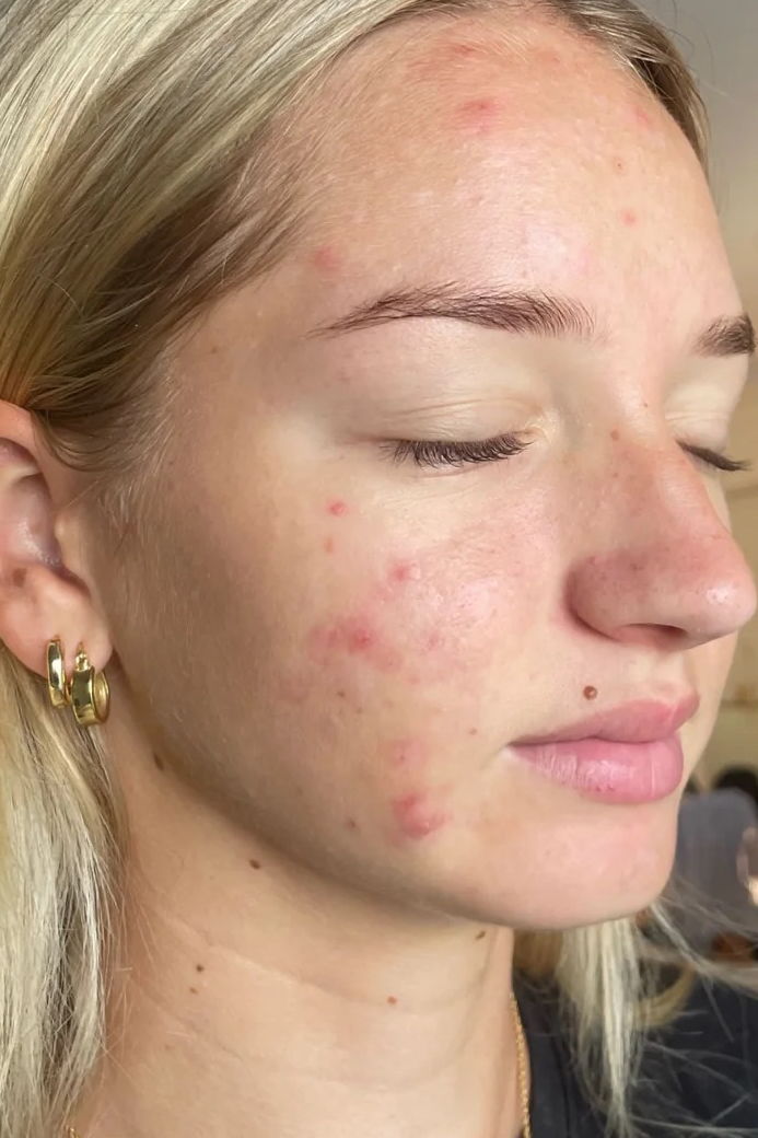ClearComplex Acne Serum