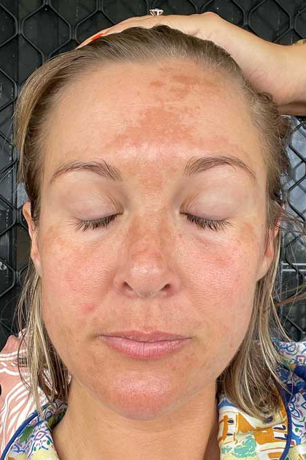 MelaMend High Strength Pigmentation Serum